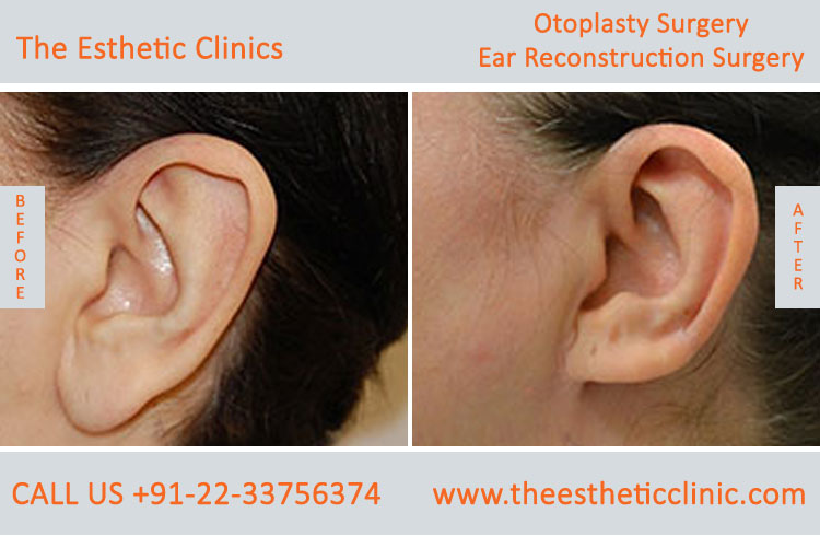 Otoplasty, Ear reconstruction surgery before after photos in mumbai india (6)